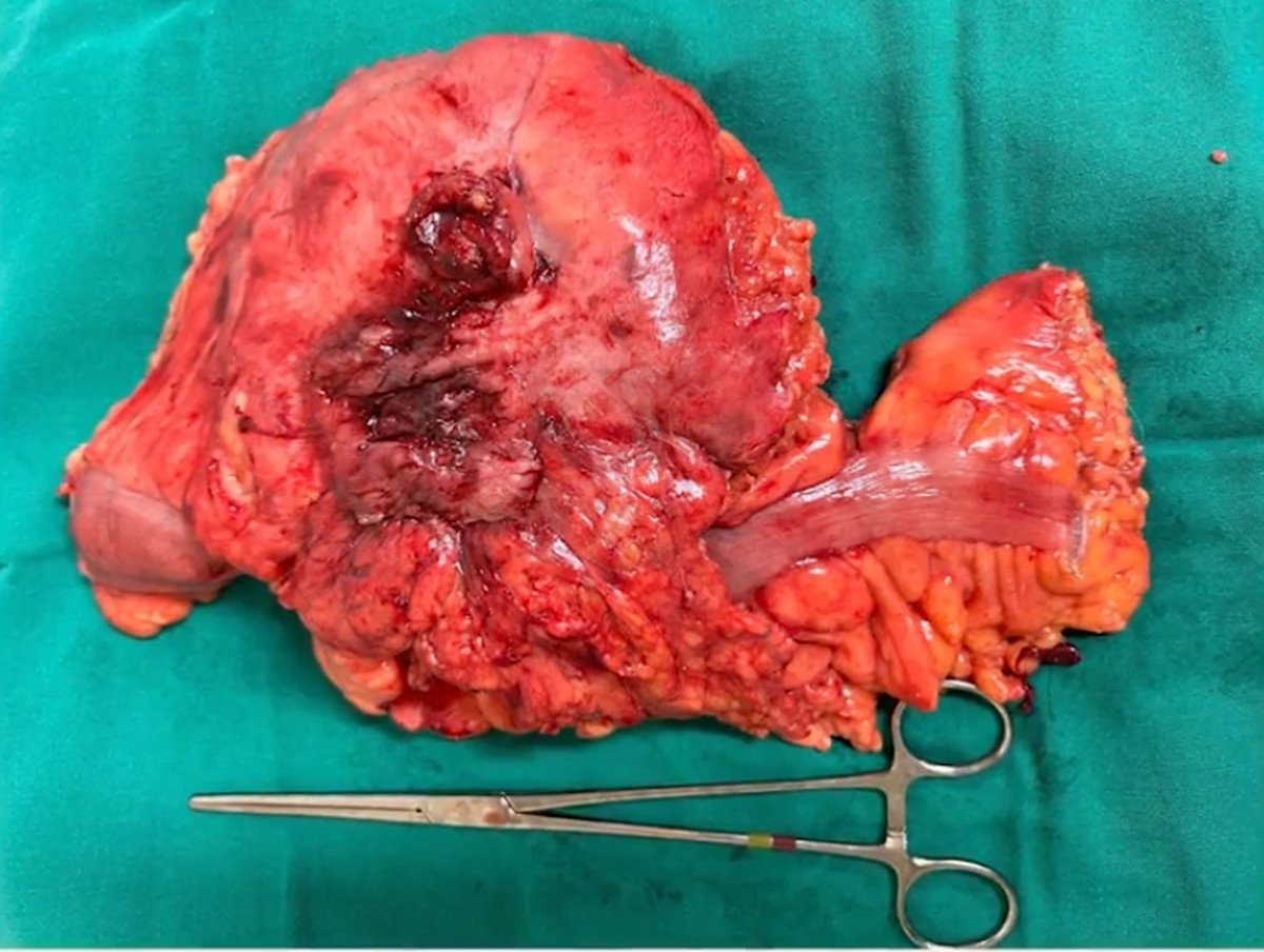 Divertículo gigante do cólon: saiba tudo sobre a doença raríssima detectada em hospital do Rio
