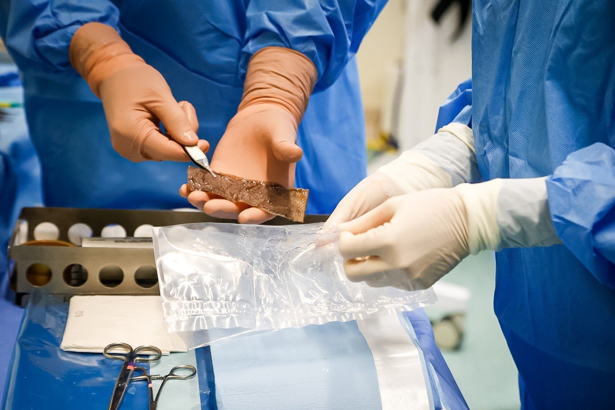 Hospital Pedro II faz primeiro transplante de pele com corpos doadores; conheça técnica para queimaduras